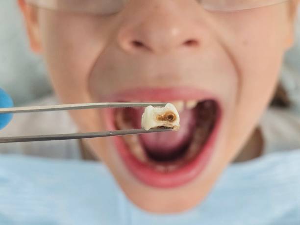 Best Emergency Wisdom Teeth Removal in Eatontown, NJ